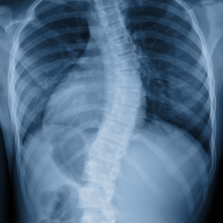 Prise en Charge de la Scoliose par la méthode des chaînes musculaires Prise en Charge de la Scoliose par la méthode des chaînes musculaires